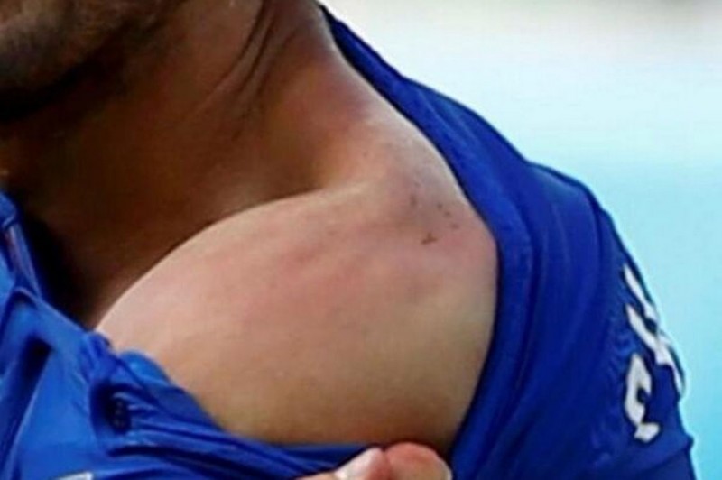 Chiellini teeth mark, after Suarez's bite in the FIFA World Cup 2014